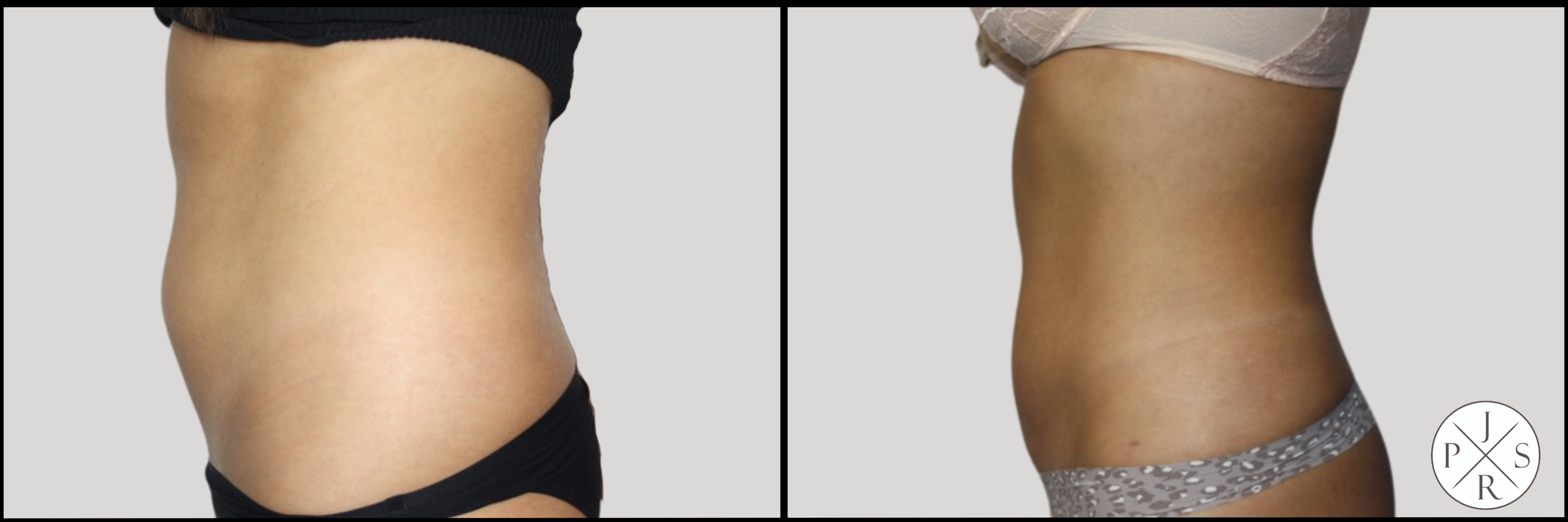 Liposuction Before & After Image